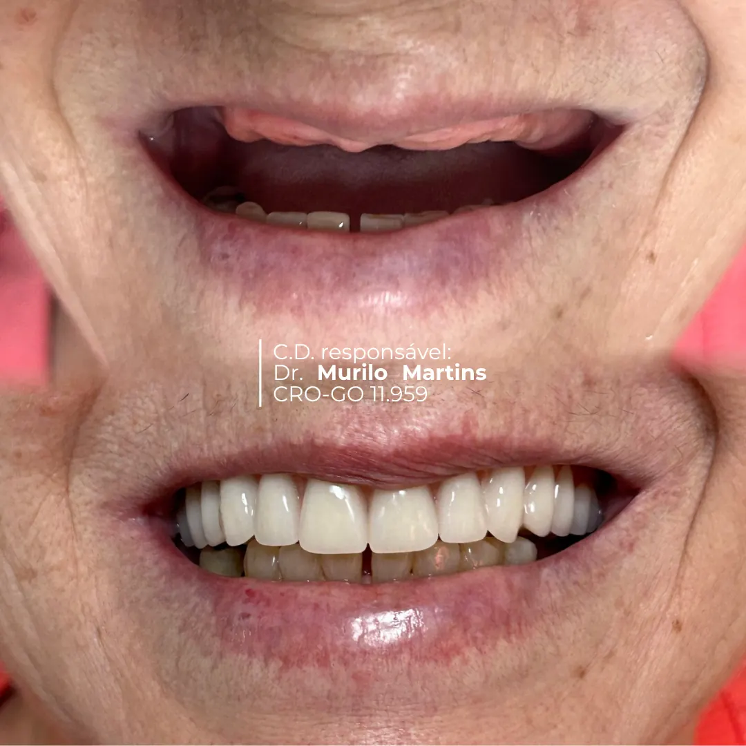Antes e depois de sorriso - Para quem é